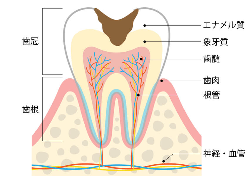 虫歯について