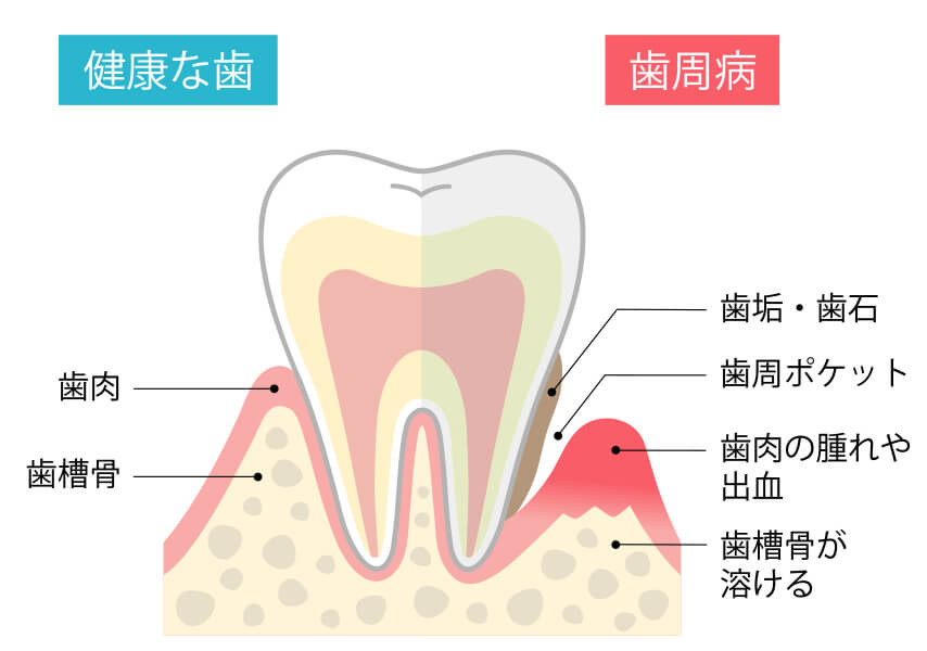 歯周病について